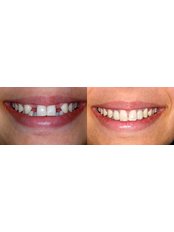 Dental Implants - Gold Dental Hospital