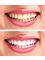 Sparks Cosmetic & Dental Surgery - Teeth whitening 