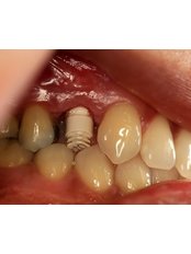 Metal-Free Implants - Thangams Dental Implant Center