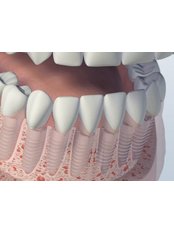 Immediate Implant Placement - Thangams Dental Implant Center
