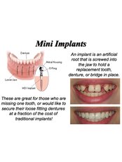 Mini Implants - Thangams Dental Implant Center