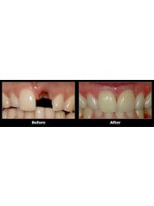 Keyhole Dental Implants - Thangams Dental Implant Center
