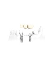 Keyhole Dental Implants - Thangams Dental Implant Center