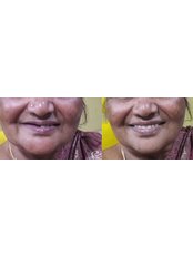 Dental Bridges - Dr. Nandhini