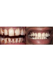 Teeth Whitening - Dr. Nandhini