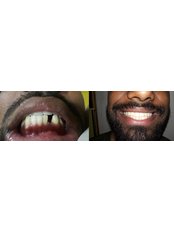 Dental Implants - Dr. Nandhini