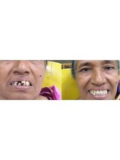 Dentures - Dr. Nandhini