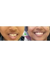 Teeth Straightening - Dr. Nandhini