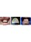 Agrawal Dental Clinic Implant and Laser Center - Dental Veneers for Gap Closure 
