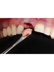 Bone Graft - Krisshnaa Dental & Multispeciality care