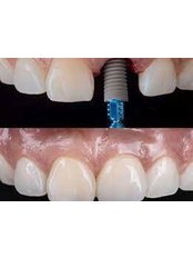Immediate Implant Placement - Krisshnaa Dental & Multispeciality care
