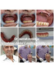 All-on-4 Dental Implants - Krisshnaa Dental & Multispeciality care