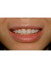 Ceramic Braces - Smile Dental Clinic