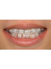 Ceramic Braces - Smile Dental Clinic