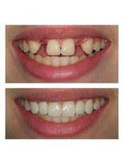 Accelerated Braces™ - Smile Dental Clinic