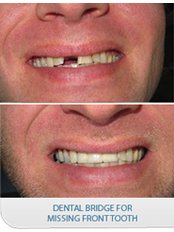 Dental Bridges - Smile Dental Clinic