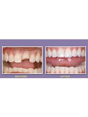 Dental Crowns - Smile Dental Clinic