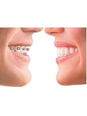 Adult Braces - Smile Dental Clinic