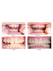 Accelerated Braces™ - Smile Dental Clinic