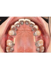 Incognito™ Braces - Smile Dental Clinic