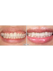 Zirconia Crown - Smile Dental Clinic