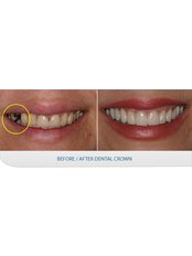 Dental Crowns - Smile Dental Clinic