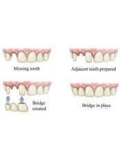 Dental Bridges - Smile Dental Clinic