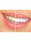Smile N Care Dental Clinics - Tooth Whitening/ Tooth Bleaching 
