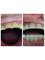 Smile On Dental Clinic - Composite build up done for a patient with worn off teeth 