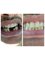 Smile On Dental Clinic - zirconium crowns given to replace missing teeth 