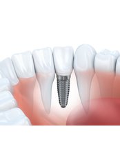 Dental Implants - AK GLOBAL DENT - A Centre For Modern Dentistry & Orthodontics