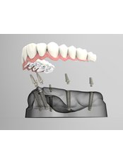 All-on-4 Dental Implants - AK GLOBAL DENT - A Centre For Modern Dentistry & Orthodontics