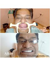 Dental Implants - COSMODENT INDIA