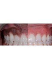 Gum Depigmentation - Dental Arch Gurgaon