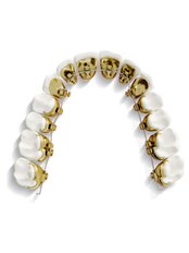 Incognito™ Braces - Dental Arch Gurgaon