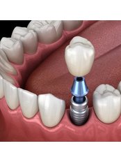 Dental Implants - Dental Arch Gurgaon