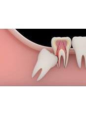 Wisdom Tooth Extraction - Dental Arch Gurgaon