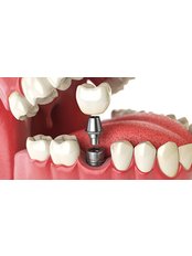 Immediate Implant Placement - Dental Arch Gurgaon
