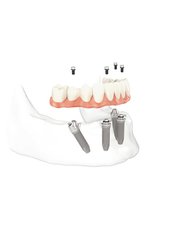All-on-4 Dental Implants - Dental Arch Gurgaon