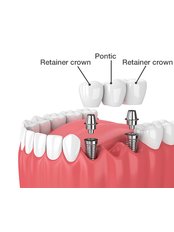 Restoration of Implants - Dental Arch Gurgaon