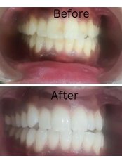 Teeth Whitening - Thyme Dental