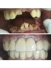 Full Mouth Rehabilitation - Thyme Dental