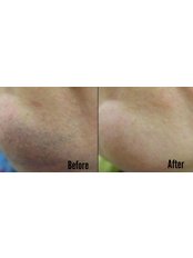 Laser Hair Removal - MaxFace Clinic
