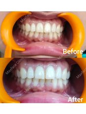 Teeth Whitening - MaxFace Clinic