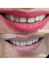 Dental Crowns - MaxFace Clinic