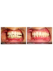 Scaling and Root Planing - Dr. Sachin Mittal's Advanced Dentistry
