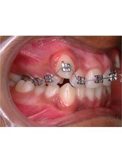 Braces - Dr. Sachin Mittal's Advanced Dentistry