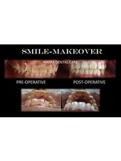 Smile Makeovers_Hisar - Nayra Dental Care