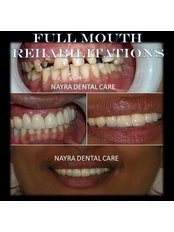 Best Smile Designing_HIsar - Nayra Dental Care