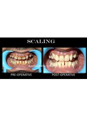 Scaling_Teeth Whitening_Hisar - Nayra Dental Care